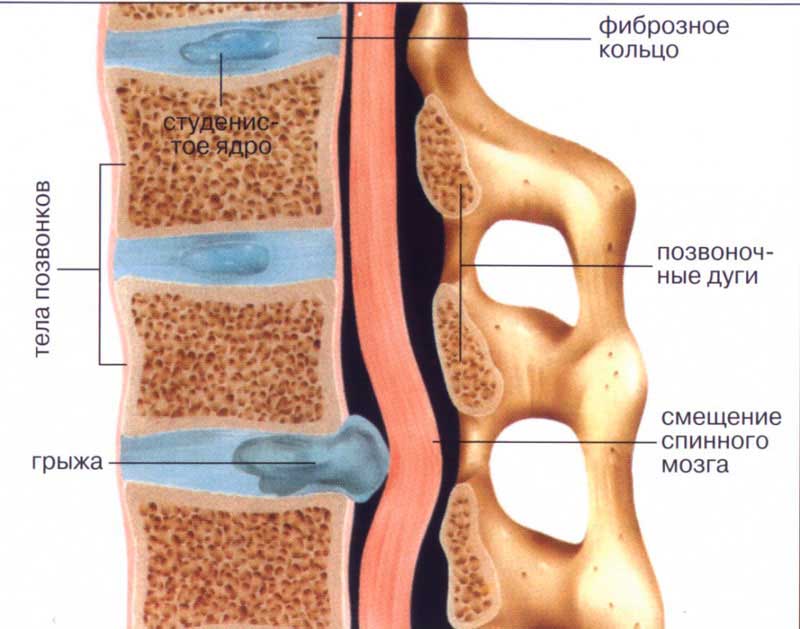 Лечение артроза суставов 3 степени: диагностика, методы лечения