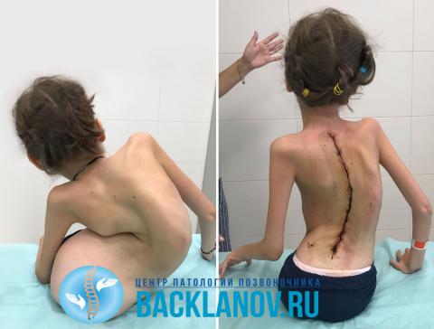 Гемангиома позвоночника, Центр патологии позвоночника Бакланова А Гемангиома позвоночника, Центр патологии позвоночника Бакланова А