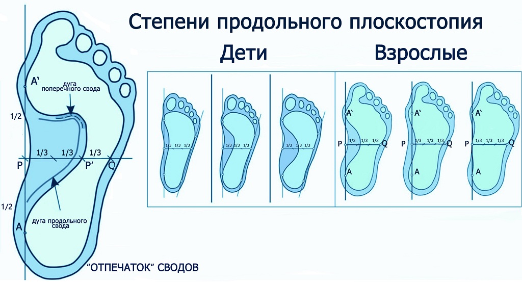 Продольное плоскостопие - лечение в Центре патологии позвоночника